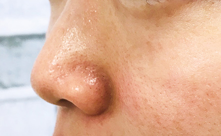 ハイドラフェイシャル症例：鼻施術後