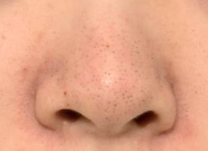 ハイドラフェイシャル症例：鼻の施術前