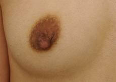 胸の整形の症例写真（術前）