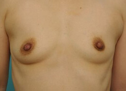 胸の整形の症例写真（術後）