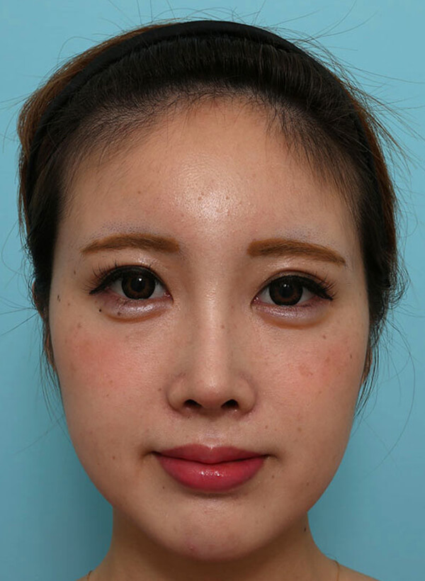 額と鼻の整形の症例写真(術後)