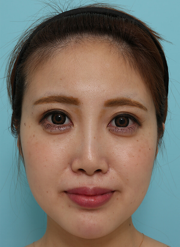 額と鼻の整形の症例写真(術前)