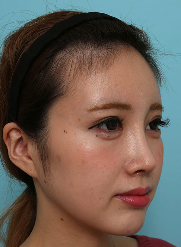 額と鼻の整形の症例写真(術後)