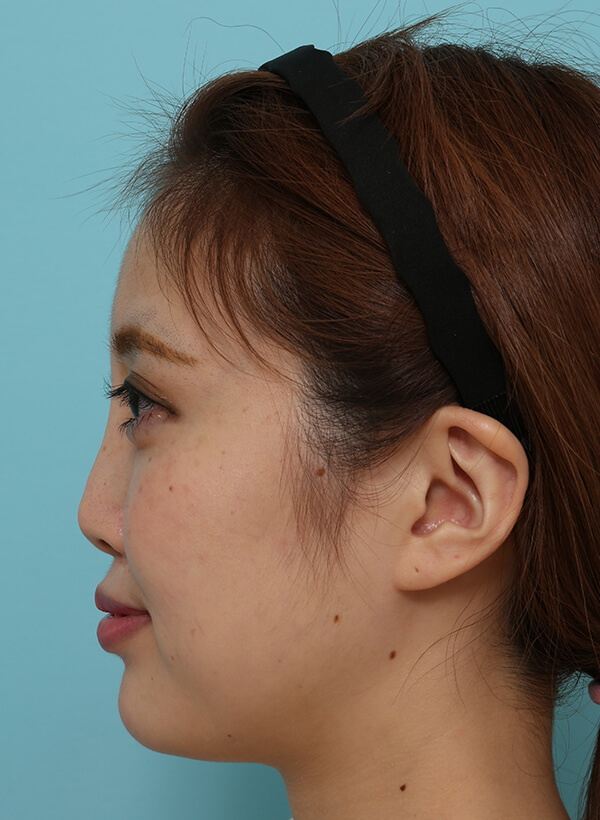 額と鼻の整形の症例写真（術前）