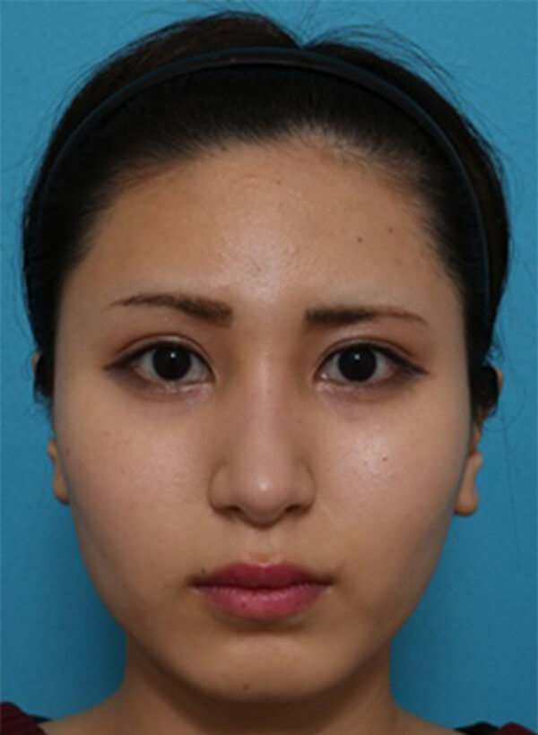 鼻と額の整形の症例写真（術後）