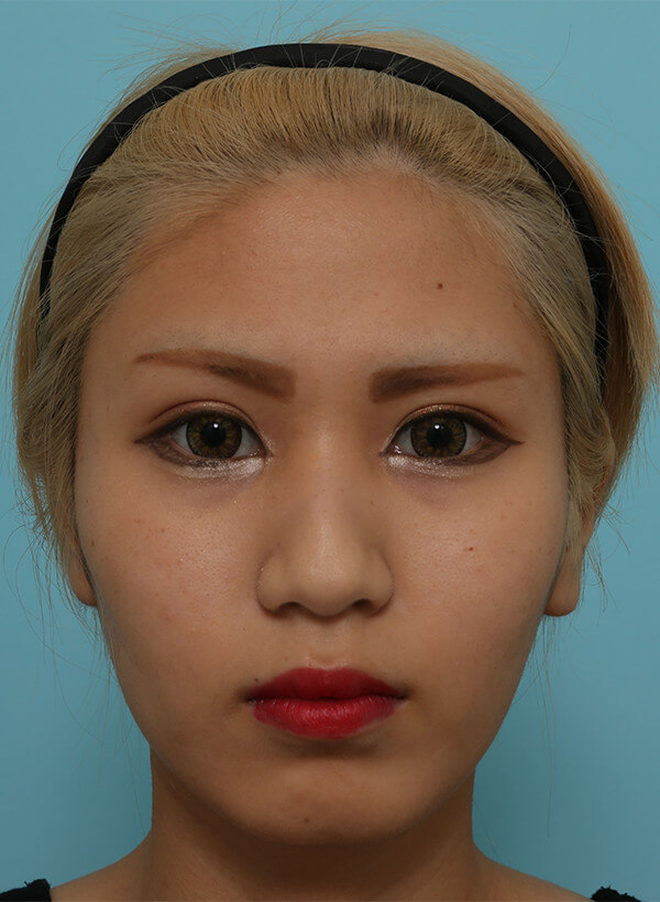鼻と額の整形の症例写真（術前）