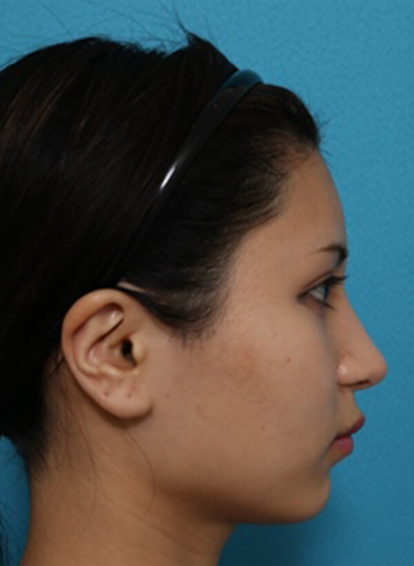 鼻と額の整形の症例写真（術後）