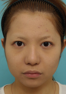 鼻の整形の症例写真(術後3カ月メイク無)