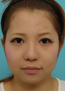 鼻の整形の症例写真(術後3カ月メイク有)