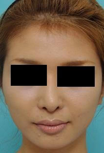 鼻の整形の症例写真（術後6カ月）