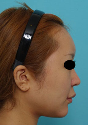 鼻の整形の症例写真（術後）