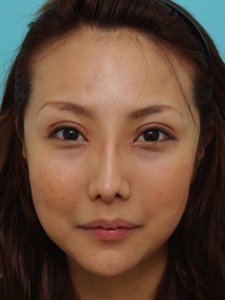 鼻の整形の症例写真（術後１か月）