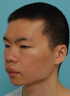 鼻の整形の症例写真（術前斜め）