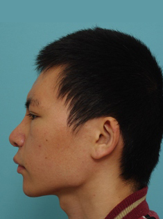 鼻の整形の症例写真（術後４週側面）
