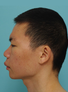 鼻の整形の症例写真（術前側面）