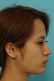 鼻の整形の症例写真（術後）