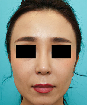 鼻の整形の症例写真(術後)