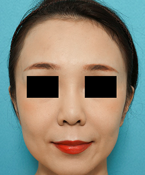 鼻の整形の症例写真(術前)
