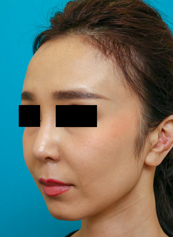 鼻の整形の症例写真