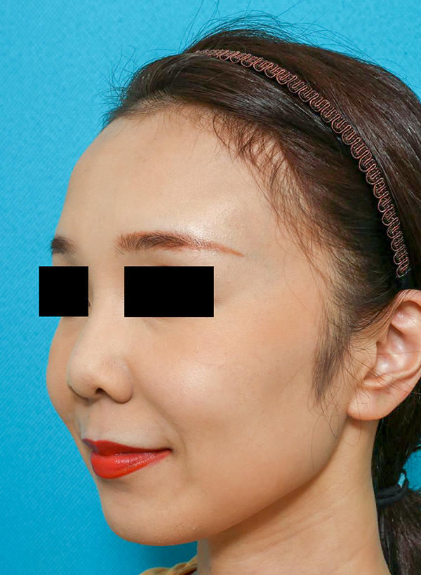 鼻の整形の症例写真