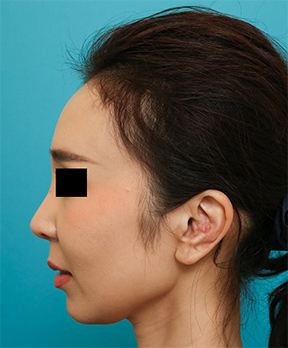鼻の整形の症例写真(術後)