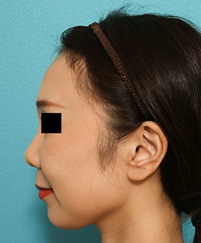 鼻の整形の症例写真(術前)