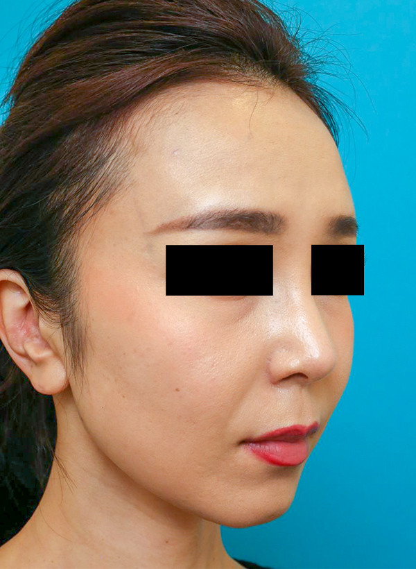 鼻の整形の症例写真(術後)