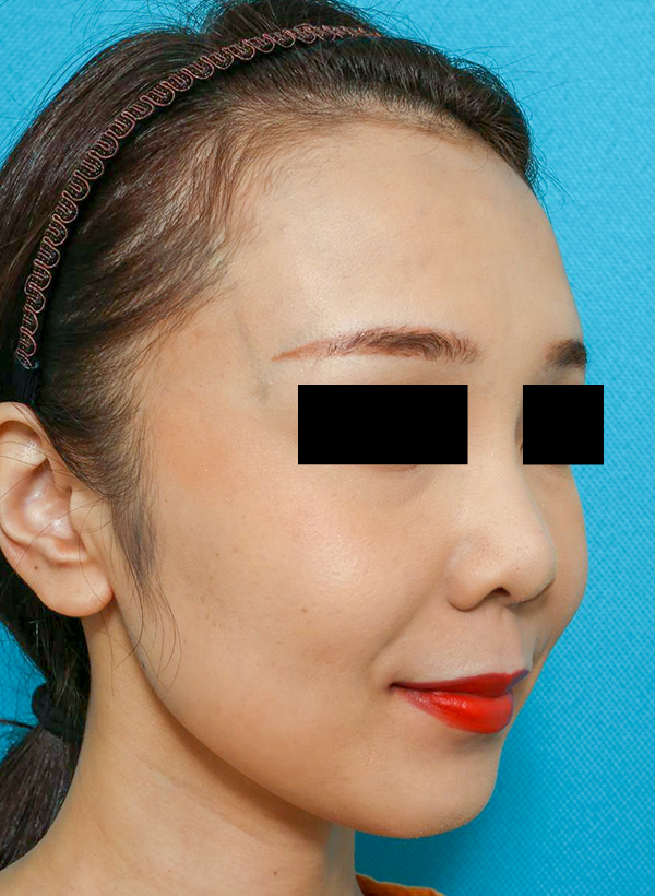 鼻の整形の症例写真(術前)