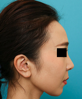 鼻の整形の症例写真(術後)