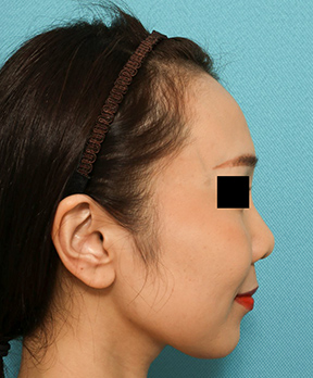 鼻の整形の症例写真(術前)