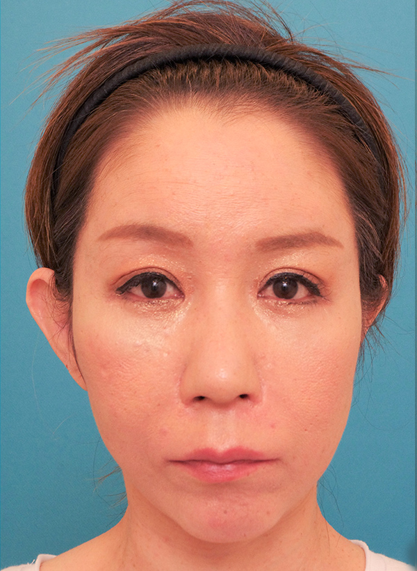 額と頬、目元と鼻の整形の症例写真(術後)