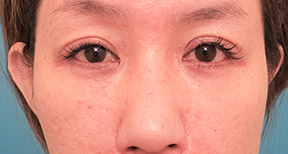 額と頬、目元と鼻の整形の症例写真(術後)