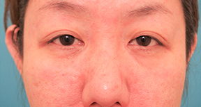 額と頬、目元と鼻の整形の症例写真(術前)