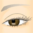 強度の眼瞼下垂