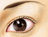 眼瞼下垂術（挙筋前転固定術）の術後