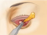 下眼瞼脱脂術の術前・切開・脂肪除去・術後イメージ