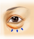 下眼瞼脱脂術の術前 正面