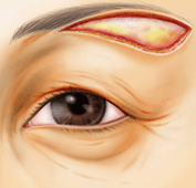 上眼瞼リフト（眉下皮膚切開術）の皮膚の切除範囲
