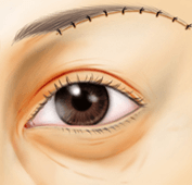 上眼瞼リフト（眉下皮膚切開術）の縫合後