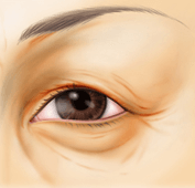 上眼瞼リフト（眉下皮膚切開術）の術前