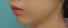 あごの整形の症例写真（術前）