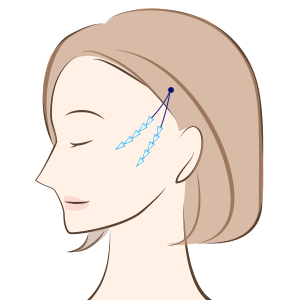 シルエットリフトの効果