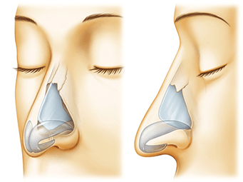 たれ鼻の鼻中隔延長術の術前