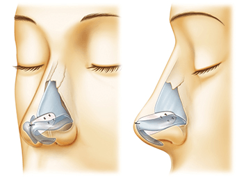 たれ鼻の鼻中隔延長術の術後
