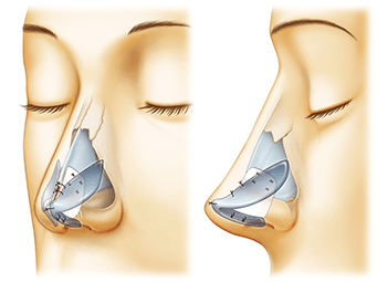だんご鼻の鼻中隔延長術の術後