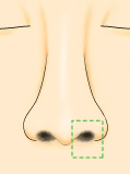 鼻孔縁形成術イラスト