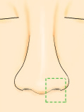 鼻孔縁形成術イラスト